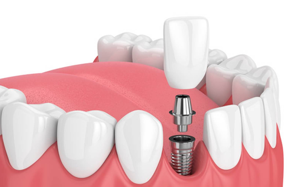 Dental Crowns and Dental Bridges hallandale beach, fl